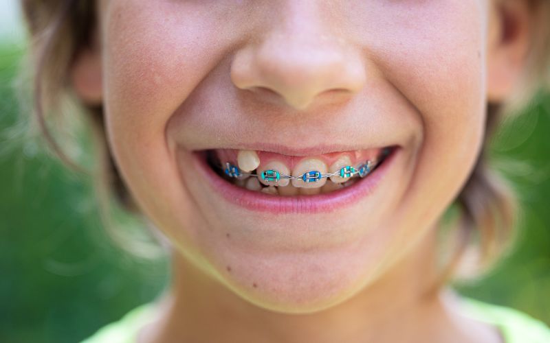 braces for children in gainesville va