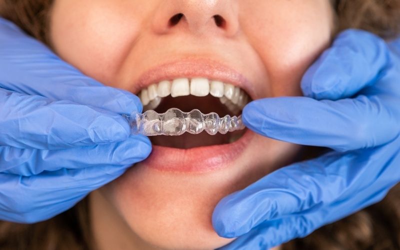 Person wearing Invisalign in Chantilly VA clear aligners from Tru Orthodontics