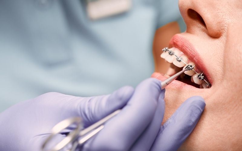 cost of braces in fairfax va