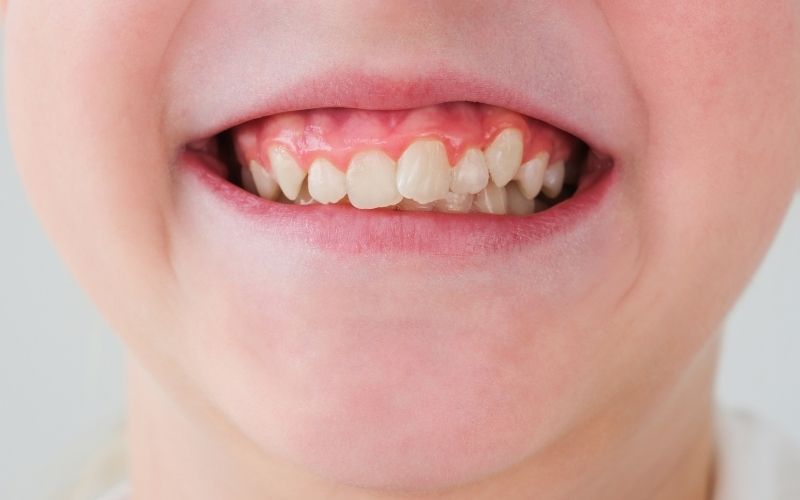 braces for bite issues in herndon va