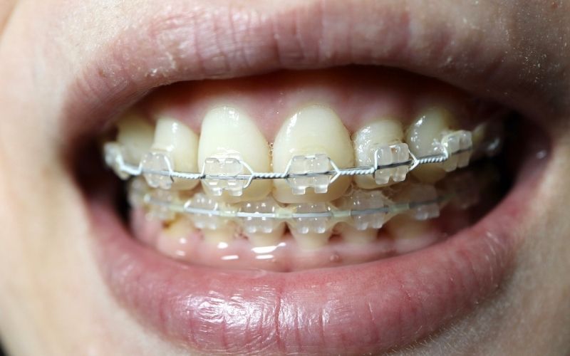 clear braces in herndon va