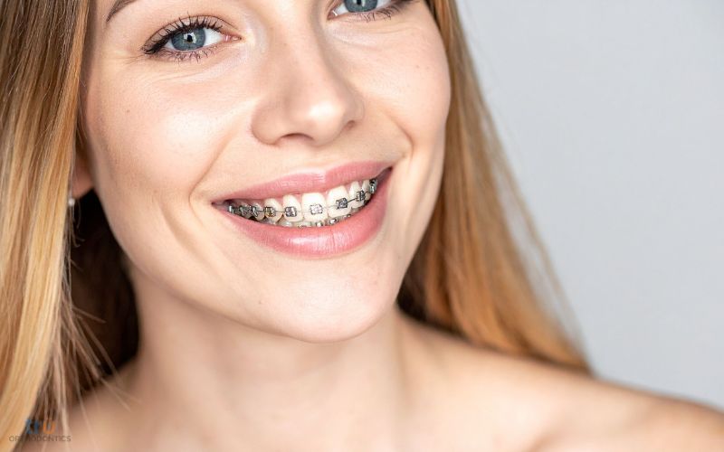 teen orthodontics west springfield va