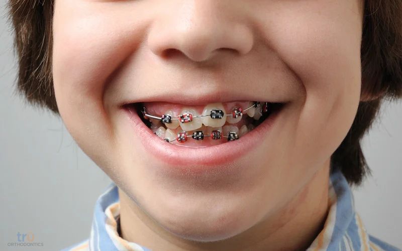 phase 1 orthodontics fairfax va